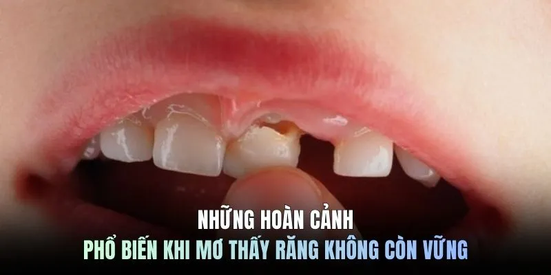 Những hoàn cảnh phổ biến khi mơ thấy răng không còn vững
